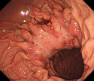 スキルス型の進行胃癌