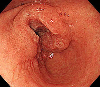 潰瘍型の進行胃癌
