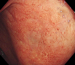 潰瘍性大腸炎1