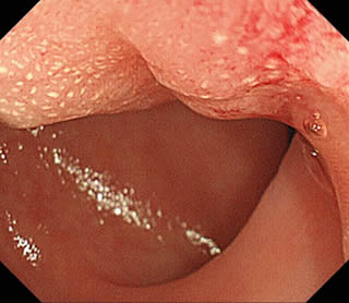 腸管子宮内膜症1